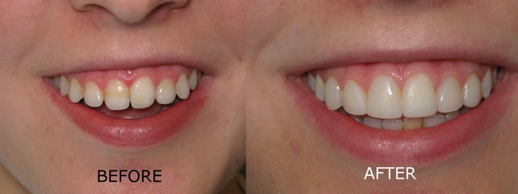 smile gallery of a woman all teeth front view before and after