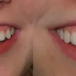 smile gallery of a woman all teeth front view before and after
