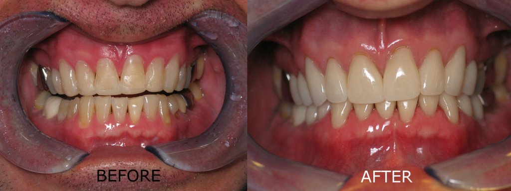 smile gallery of a man all teeth front view before and after