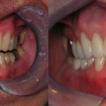 smile gallery of a man all teeth front view before and after