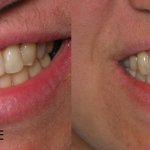 smile gallery of a man all teeth front view before and after- missing tooth