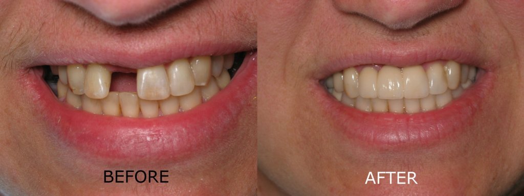 smile gallery of a man all teeth front view before and after- missing tooth