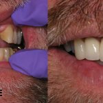 smile gallery before and after of a man with a mustache 