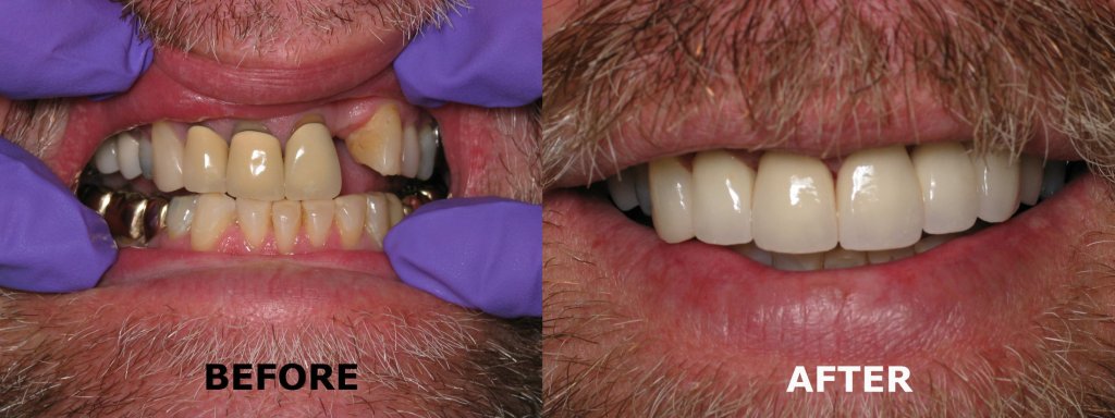 smile gallery before and after of a man with a mustache