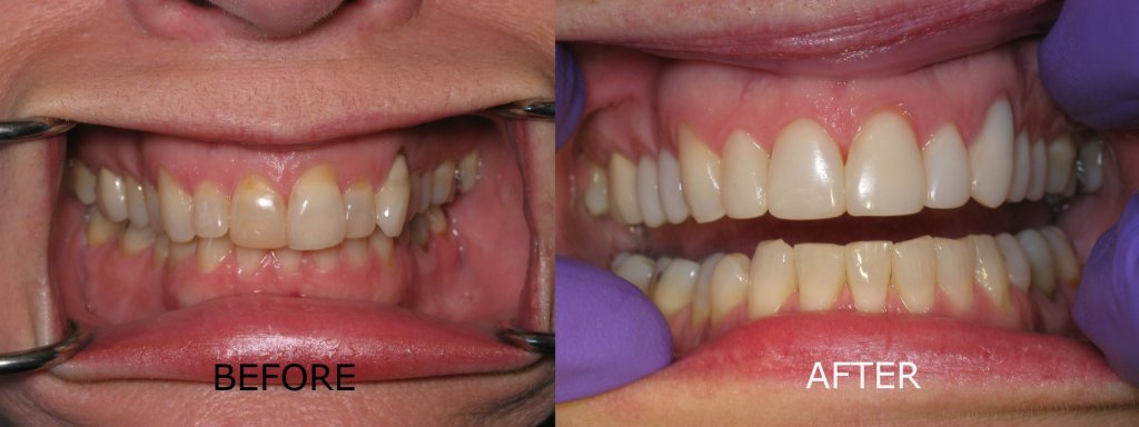 smile gallery of a man all teeth front view before and after
