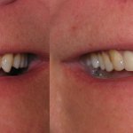 smile gallery of a man all teeth front view before and after