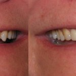 smile gallery of a man all teeth front view before and after