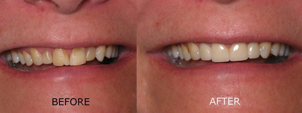 smile gallery of a man all teeth front view before and after