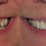 smile gallery of a man all teeth front view before and after