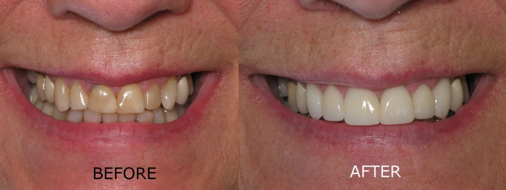smile gallery of a man all teeth front view before and after