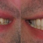 smile gallery of a man all teeth front view before and after