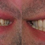 smile gallery of a man all teeth front view before and after