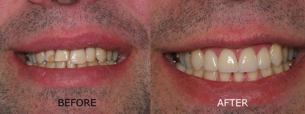 smile gallery of a man all teeth front view before and after
