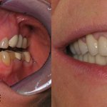 smile gallery of a man all teeth front view before and after