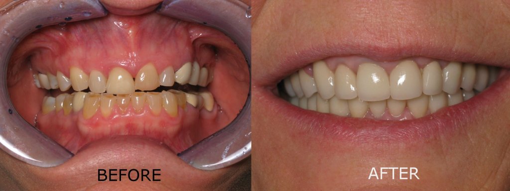 smile gallery of a man all teeth front view before and after