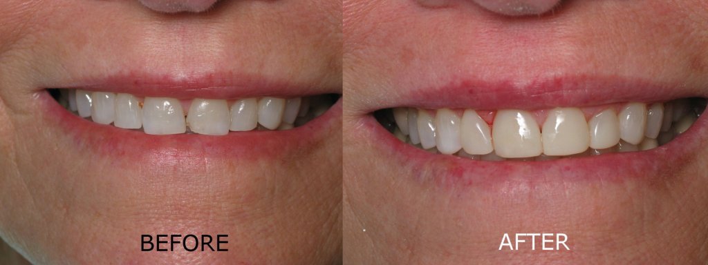 smile gallery of a woman all teeth front view before and after