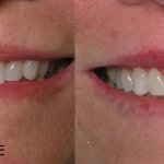 smile gallery of a woman all teeth front view before and after