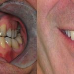 smile gallery of a man all teeth front view before and after