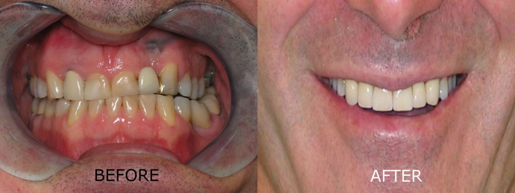 smile gallery of a man all teeth front view before and after