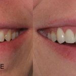 smile gallery all teeth front view before and after
