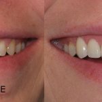 smile gallery all teeth front view before and after