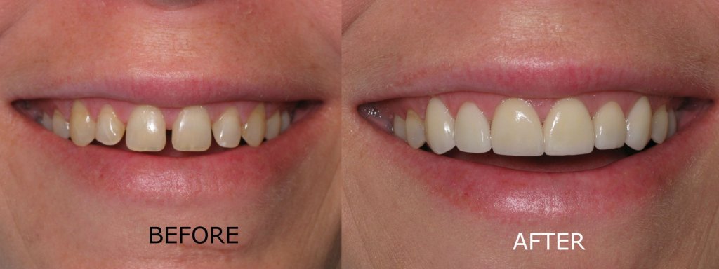 smile gallery all teeth front view before and after