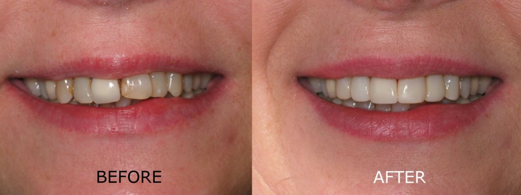 smile gallery of a woman all teeth front view before and after