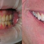smile gallery of a man all teeth front view before and after