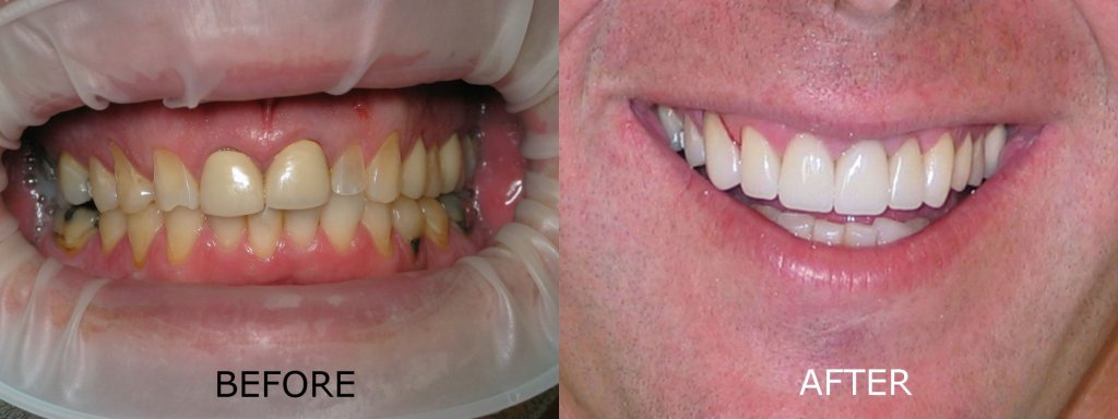smile gallery of a man all teeth front view before and after