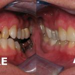 smile gallery of a man all teeth front view before and after