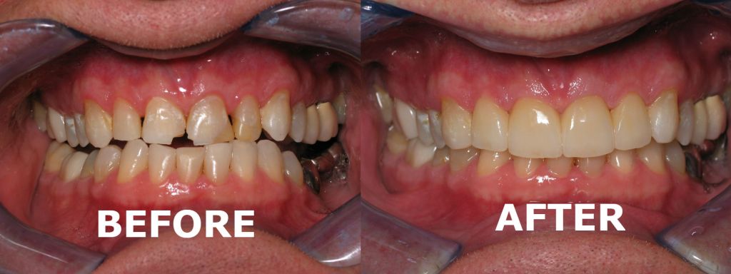 smile gallery of a man all teeth front view before and after